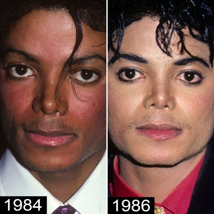 Michael Jackson Plastic Surgery