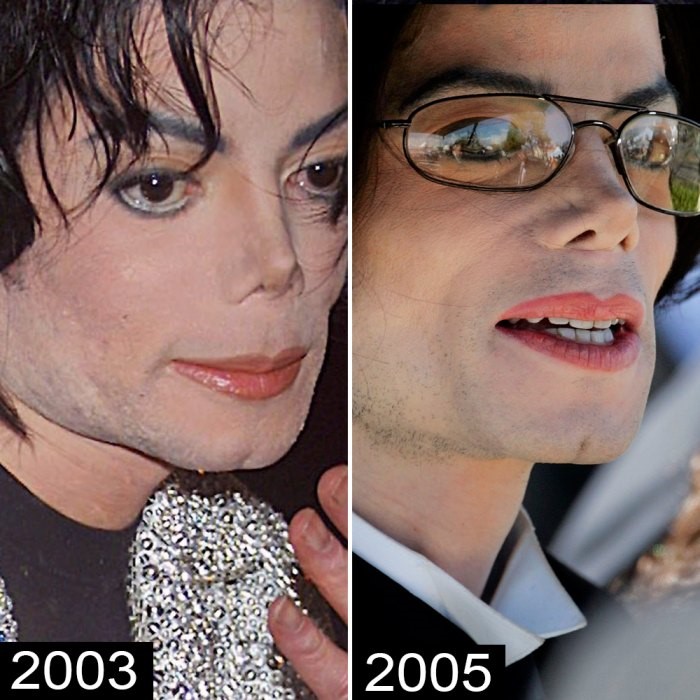 Michael Jackson Before and After Plastic Surgery and Transformation